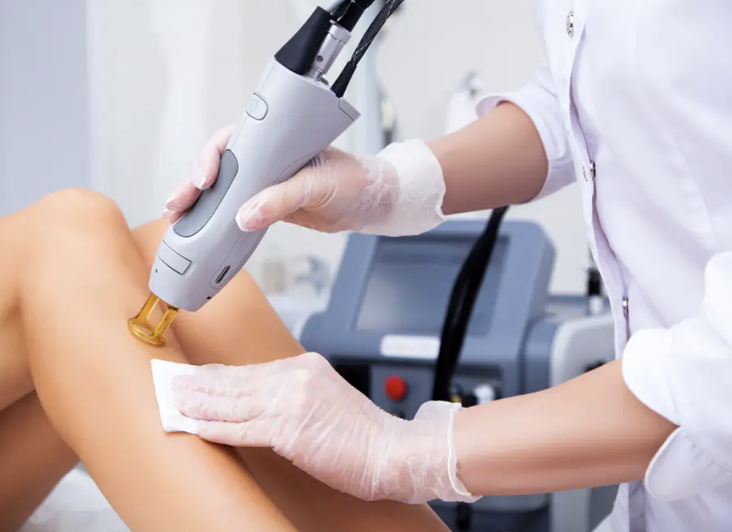 Séance d'épilation au laser sur la jambe, machine Candela en arrière-plan